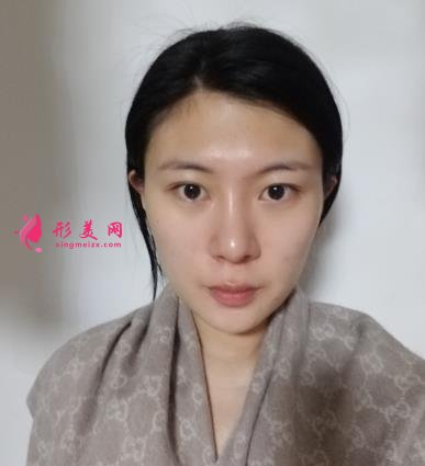 深圳陽光整形醫(yī)院雙眼皮怎么樣？效果好嗎？手術(shù)真實(shí)價格費(fèi)用參考