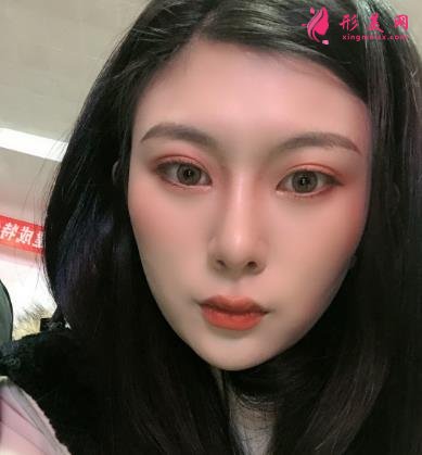 深圳陽光整形醫(yī)院雙眼皮怎么樣？效果好嗎？手術(shù)真實(shí)價格費(fèi)用參考