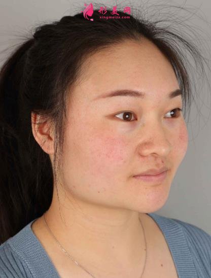 西安國際醫(yī)學(xué)中心整形醫(yī)院怎么樣？下頜角削骨案例及價格表2021均價一覽