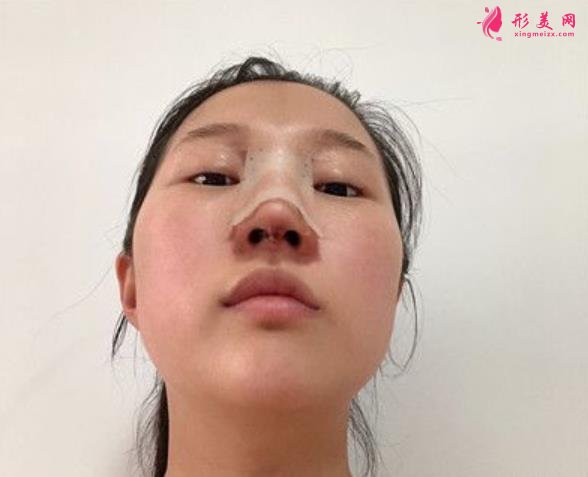 溫州藝星整形美容醫(yī)院做隆鼻怎么樣？好不好？專家案例價格收費一覽