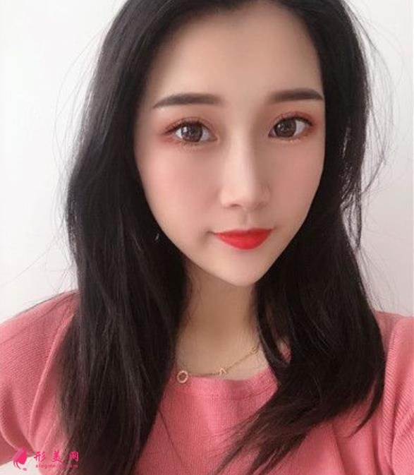 溫州藝星整形美容醫(yī)院做隆鼻怎么樣？好不好？專家案例價格收費一覽