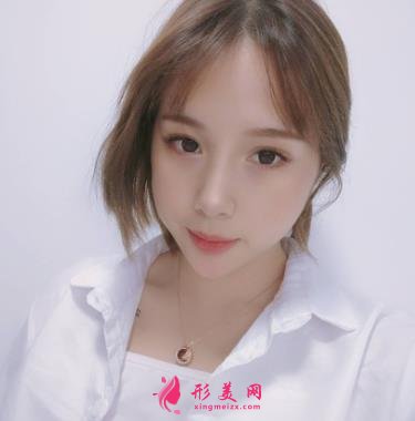 秦皇島市中醫(yī)院醫(yī)學(xué)美容科自體脂肪全臉填充案例一覽！含全新價(jià)格表展示