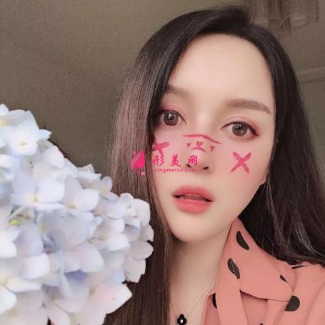 杭州美萊高士乾做的鼻子怎么樣？2021隆鼻案例+價(jià)格表曝光