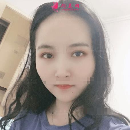 濟(jì)南中心醫(yī)院整形科怎么樣？附雙眼皮價(jià)格披露及案例效果一覽