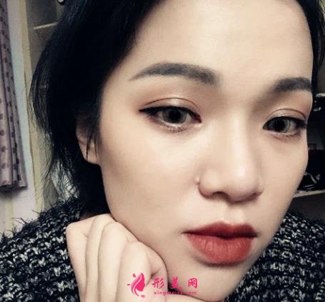 嘉興第一人民醫(yī)院整形科怎么樣?做雙眼皮案例效果圖和價格表展示