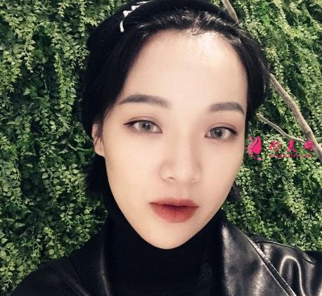 嘉興第一人民醫(yī)院整形科怎么樣?做雙眼皮案例效果圖和價格表展示