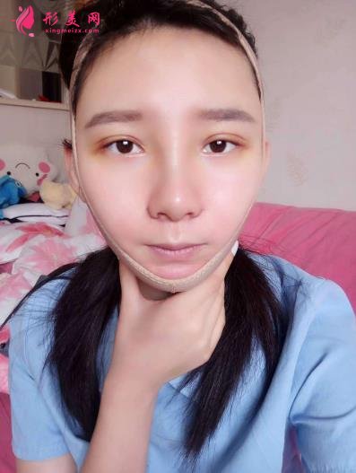 武漢同濟(jì)整形科怎么樣？做磨骨口碑案例~~恢復(fù)照片記錄反饋