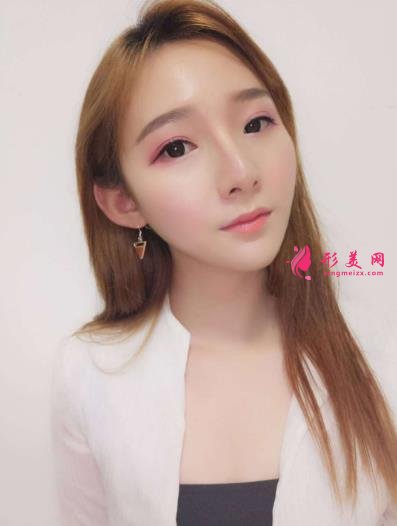 武漢同濟(jì)整形科怎么樣？做磨骨口碑案例~~恢復(fù)照片記錄反饋