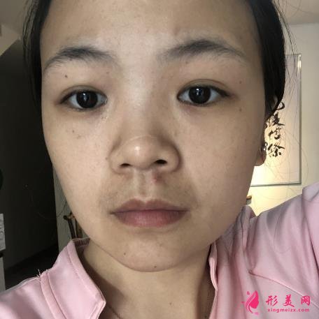 浙江省中醫(yī)院車菲掛號容易嗎?去眼袋多少錢？附案例參考