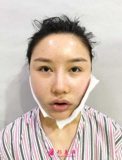 成都排名第一的整容醫(yī)院是誰？對比華西口腔李繼華磨骨案例怎么樣？