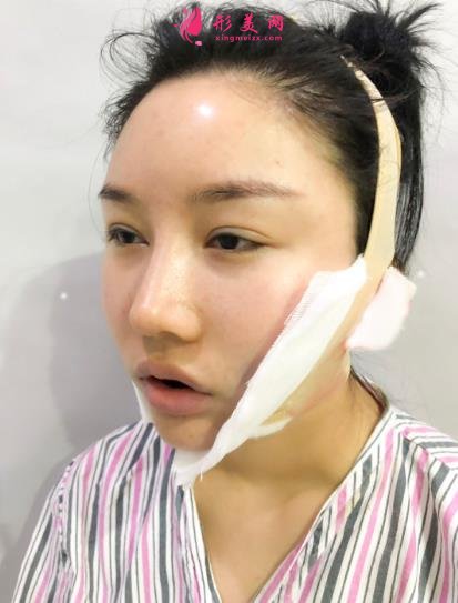 成都排名第一的整容醫(yī)院是誰？對比華西口腔李繼華磨骨案例怎么樣？