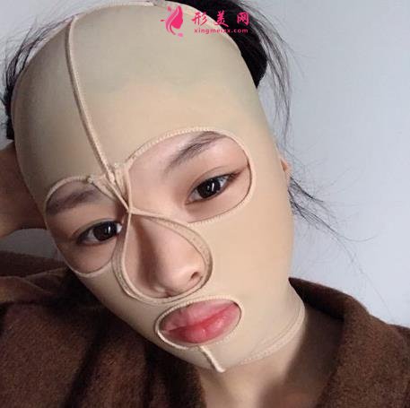 成都顴骨內(nèi)推哪家醫(yī)院好?成都友誼醫(yī)院90天恢復(fù)案例給你參考