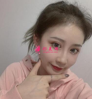 北京協(xié)和醫(yī)院整形科割雙眼皮怎么樣?案例效果和價格表費用分享