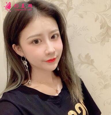 北京協(xié)和醫(yī)院整形科割雙眼皮怎么樣?案例效果和價格表費用分享