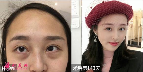 暨南大學附屬第一醫(yī)院整形科價格表_醫(yī)生簡介_祛眼袋案例一覽