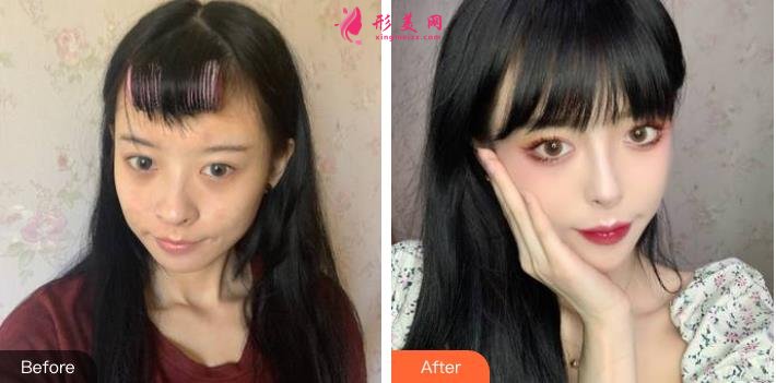 暨南大學附屬第一醫(yī)院整形科價格表_醫(yī)生簡介_祛眼袋案例一覽