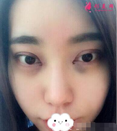 攀枝花第五人民醫(yī)院整形美容科做雙眼皮咋樣?效果和價(jià)格表上線!