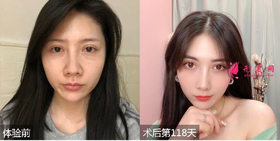 深圳富華醫(yī)院整形價格表一覽！有隆鼻效果為大家展示！