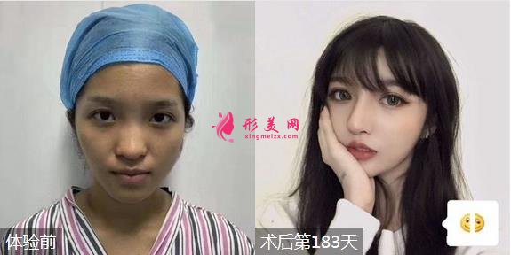 北京沃爾劉彥軍醫(yī)生隆鼻怎么樣？專家案例及價(jià)格表出爐！