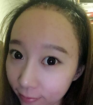 廣州倍生女性發(fā)際線調(diào)整案例