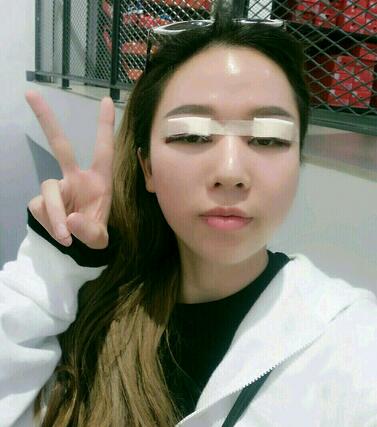 廣州妍雅割雙眼皮+開眼角恢復(fù)日記