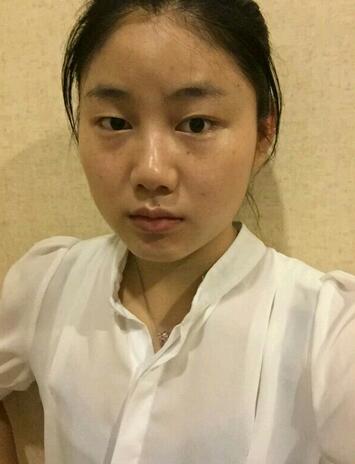 廣州妍雅割雙眼皮后恢復(fù)過程圖