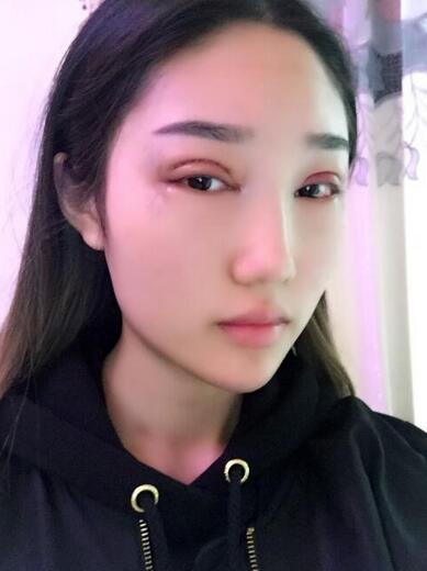 成都玉顏割雙眼皮+開眼角真實案例