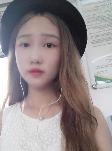 成都玉顏割雙眼皮+開眼角真實案例