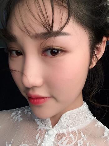 成都玉顏割雙眼皮+開眼角真實案例