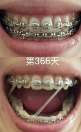 牙齒矯正前后對比圖，成人牙齒矯正費用9800元——成都格林口腔醫(yī)院