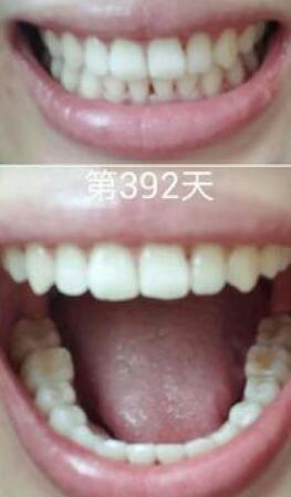 牙齒矯正前后對比圖，成人牙齒矯正費用9800元——成都格林口腔醫(yī)院