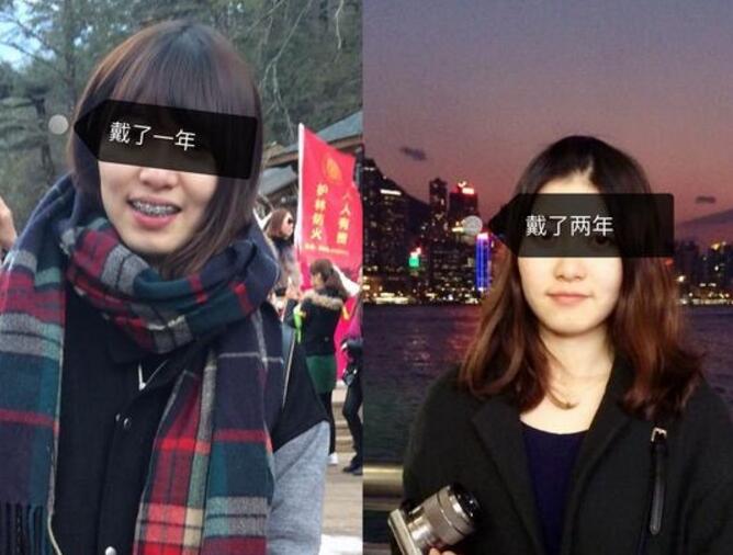 成都牙齒矯正前后對比圖分享——成都格林口腔