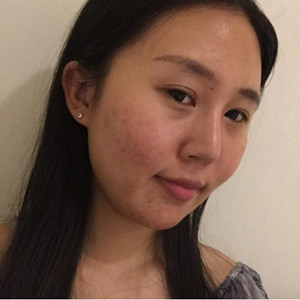 光子嫩膚手術(shù)前后過程以及對(duì)比照片分享，武漢美都朱紅霞醫(yī)生做的