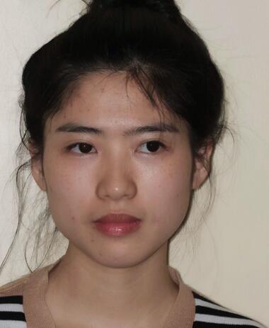 北京八大處下頜角截骨前后效果對(duì)比