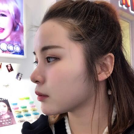 北京八大處李戰(zhàn)強(qiáng)隆鼻案例