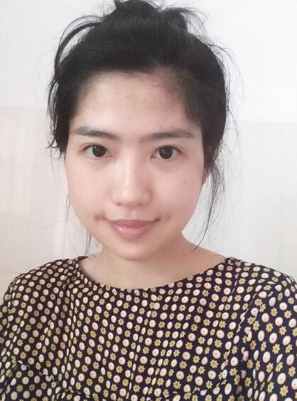 北京八大處下頜角截骨前后效果對(duì)比