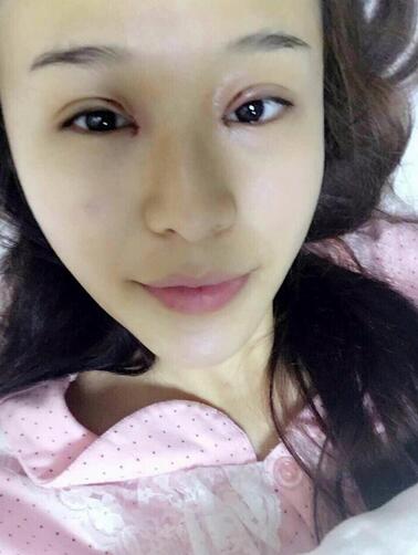 杭州科發(fā)源龍都整形開眼角+割雙眼皮恢復(fù)記錄