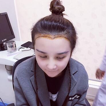 發(fā)際線調(diào)整效果對比圖 杭州科發(fā)源龍都發(fā)際線種植