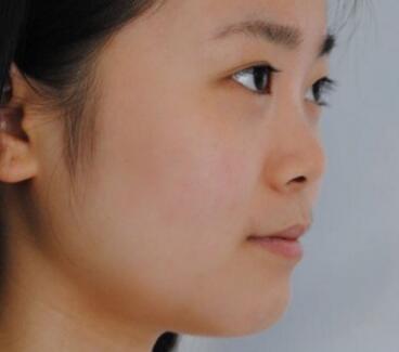 鼻綜合整形價格和真實恢復期圖片