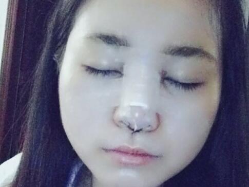 鼻綜合整形價格和真實恢復期圖片