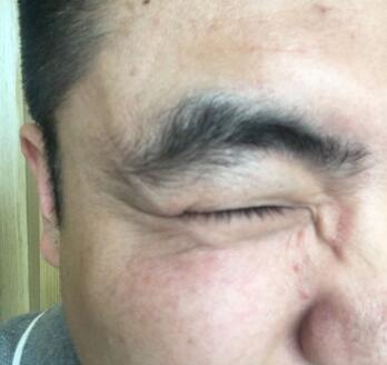 男生注射肉毒素去除抬頭紋魚尾紋案例分享