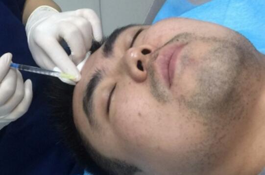 男生注射肉毒素去除抬頭紋魚尾紋案例分享
