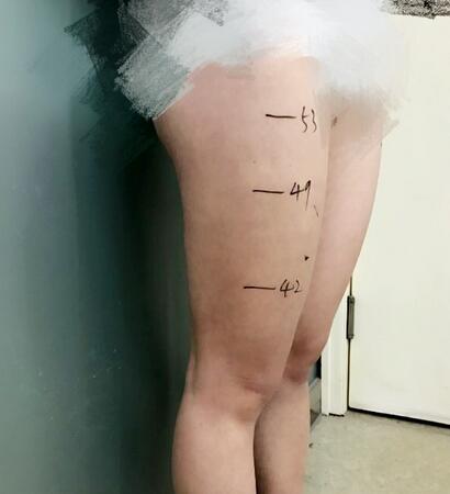 天津繆慈大腿吸脂前后對比圖