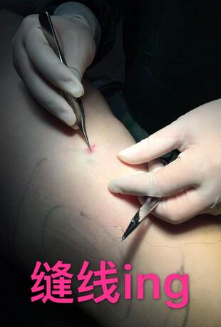 天津繆慈大腿吸脂前后對比圖