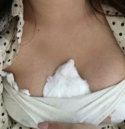 北京八大處劉春軍隆胸案例分享