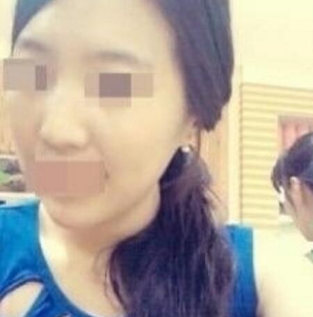 鼻翼縮小和隆鼻手術(shù)對(duì)比圖和整形日記