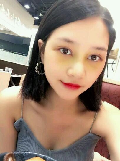 北京醫(yī)院趙紅藝做的雙眼皮+假體隆鼻