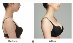 假體隆胸可以維持多久時間?